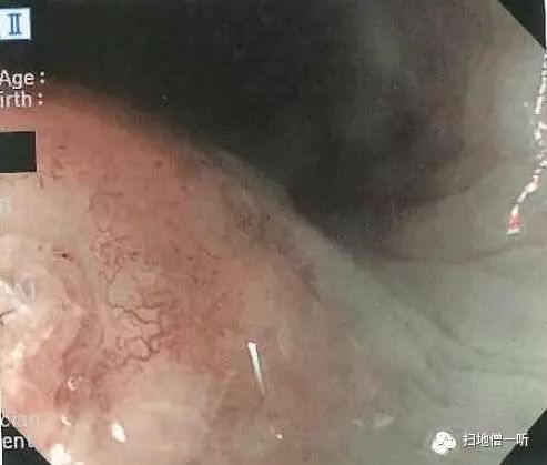 病理解读：神经内分泌癌伴扁平上皮癌