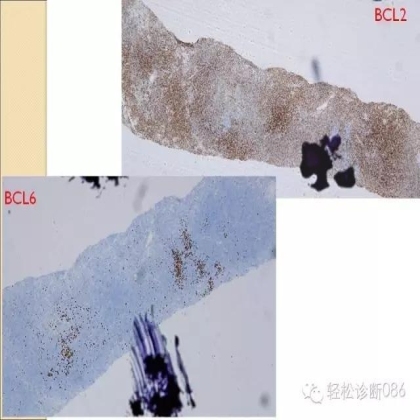 滤泡性淋巴瘤