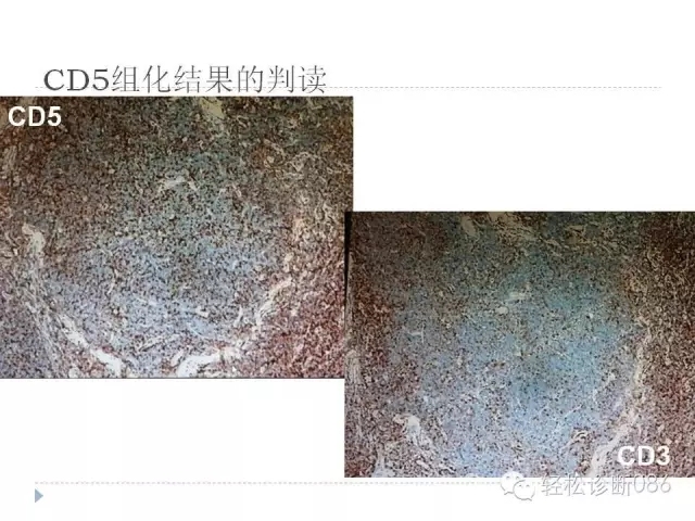 关于套细胞淋巴瘤的总结课件