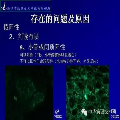 探讨免疫组织学在肾穿标本中的应用