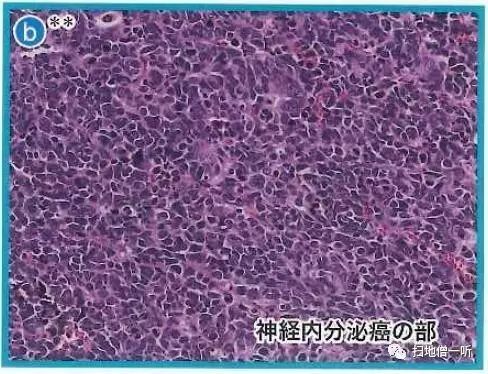病理解读：神经内分泌癌伴扁平上皮癌