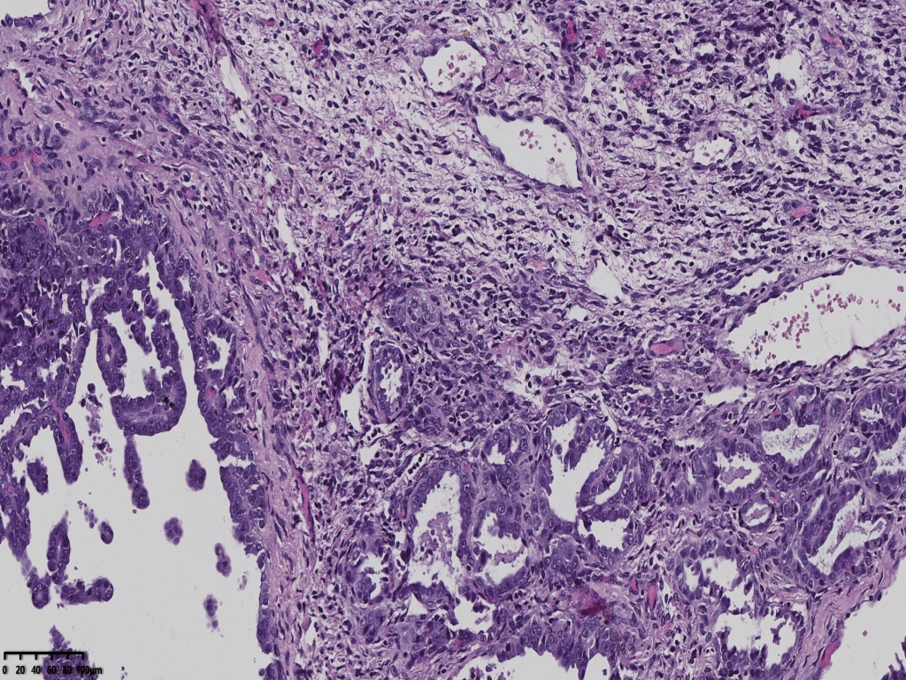 子宫透明细胞癌？