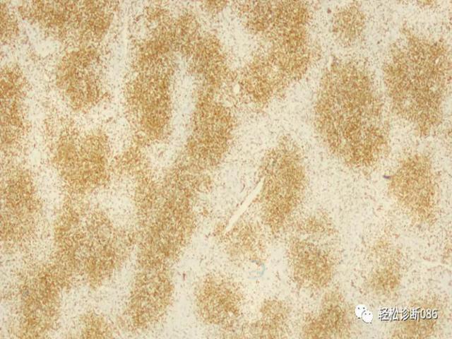 滤泡辅助T细胞（TFH）及其相关淋巴瘤（13）