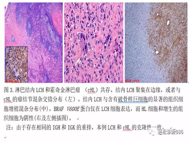 组织细胞起源疾病（4）——肿瘤性病变（LCH）