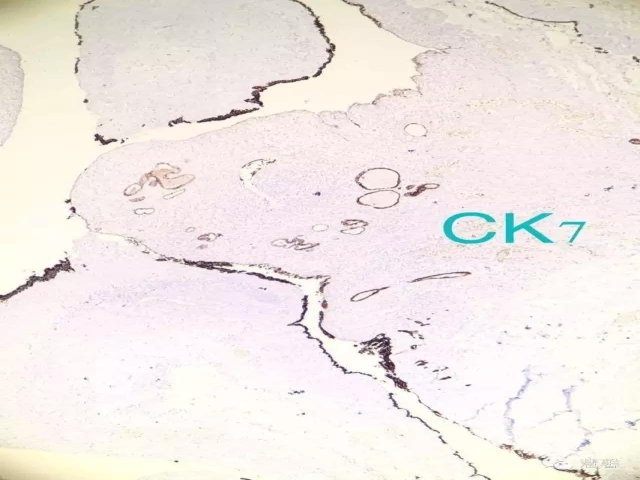 囊性肾瘤（杨倩分享，王哲老师等讲解及讨论）