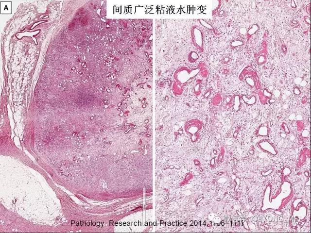 乳腺梭形细胞病变的病理诊断及进展（一）