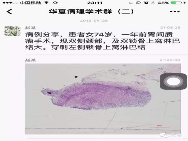 皮病性淋巴结炎，与格列卫治疗相关？（赵洋病例分享，华夏病理学术二群讨论）