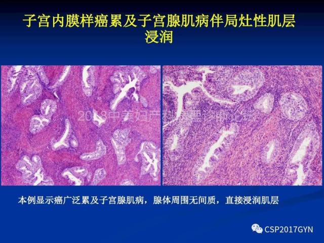 子宫内膜癌：诊断与进展