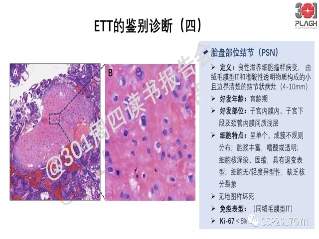 中间型滋养细胞肿瘤的诊断及鉴别诊断