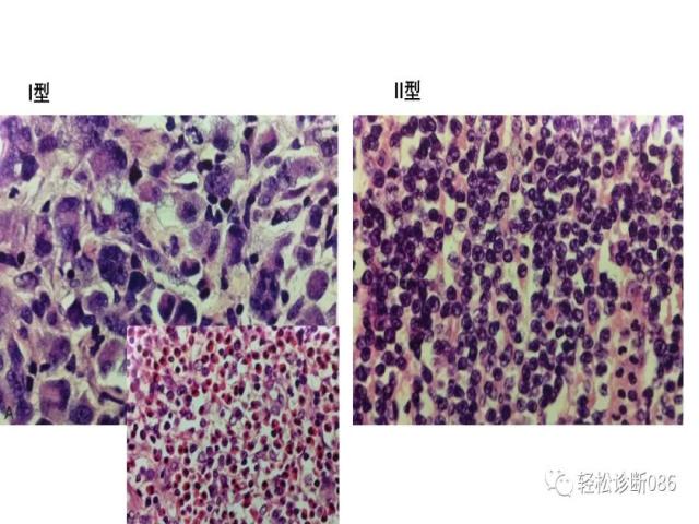 肠道T细胞淋巴瘤