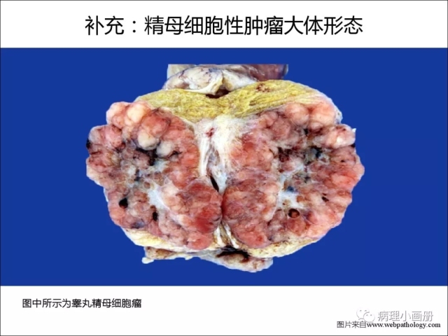 泌尿病理--精原细胞瘤VS精母细胞瘤