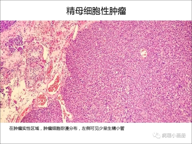 泌尿病理--精原细胞瘤VS精母细胞瘤