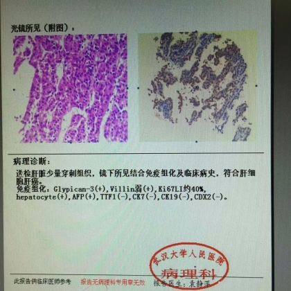 病理科新技术（二）：穿刺组织学明确诊断