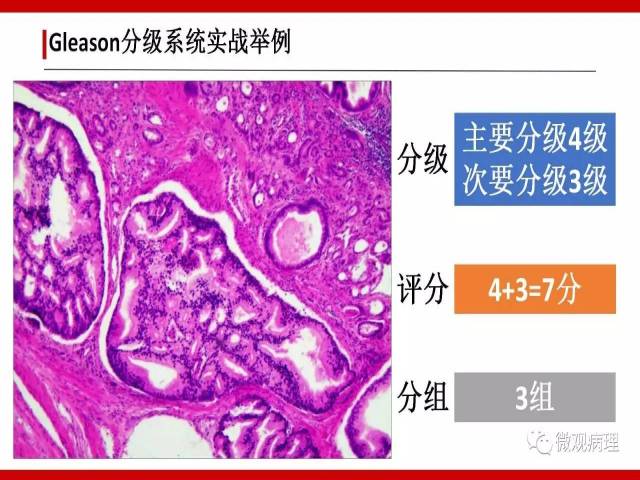 前列腺癌Gleason分级系统的前世今生