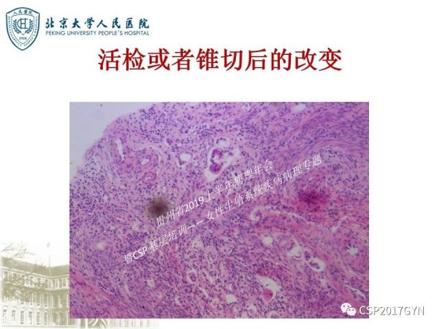 中华病理学会基层培训遵义站讲座（三）——宫颈鳞状上皮病变的病理诊断与鉴别诊断