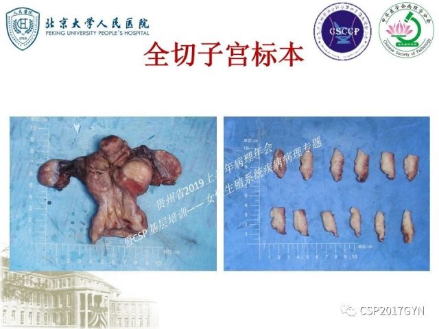 中华病理学会基层培训遵义站讲座（三）——宫颈鳞状上皮病变的病理诊断与鉴别诊断