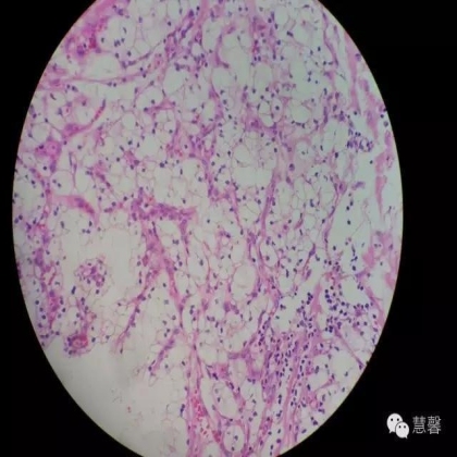 透明细胞乳头状肾细胞癌？TFE3 Traslocation Carcinoma？（赵洋分享，孔祥田(Max)*NM老师讲解）
