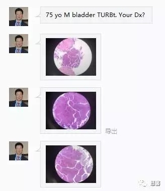 低级别尿路上皮乳头状癌（汤姆与孔祥田老师两个病例对比，孔祥田(Max)*Sacramento*CA]讲解）