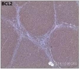 小B细胞NHL——FL（1）