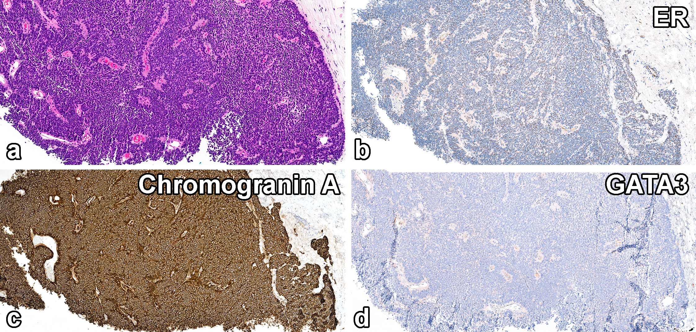 读文献，学病理-乳腺乳头状肿瘤难点总结（一）