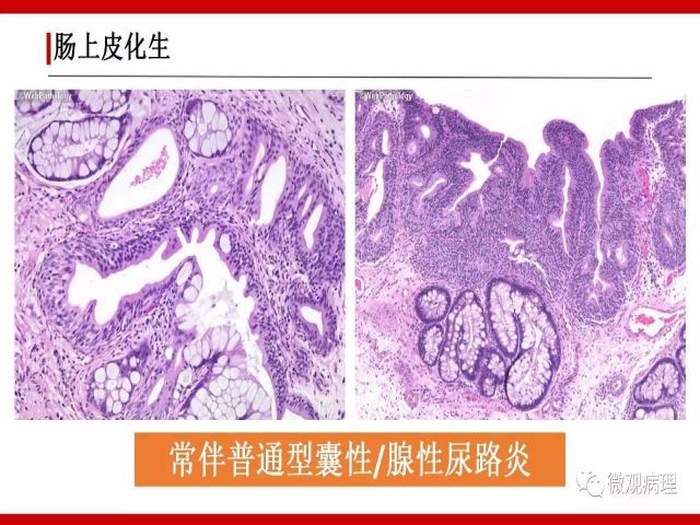 泌尿课程/尿路腺样病变的诊断要点