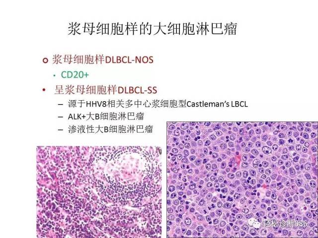 浆细胞相关肿瘤的病理诊断及鉴别诊断