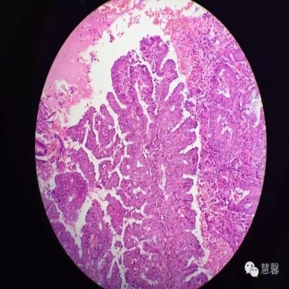 高分化子宫内膜样癌与分泌期子宫内膜、黏液腺癌的鉴别（孔令英分享，刘从容老师讲解）
