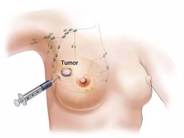 科普 | 乳腺癌的病理活检