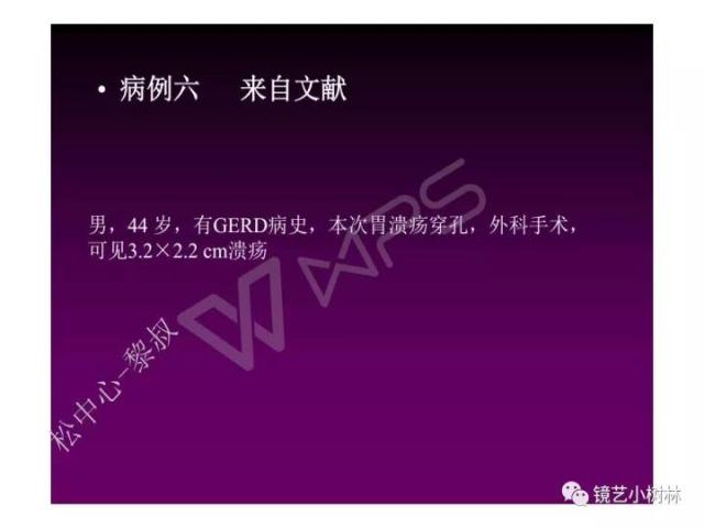 上消化道早癌病理的学习心得体会（附胃牵手癌的病例特点文献学习）
