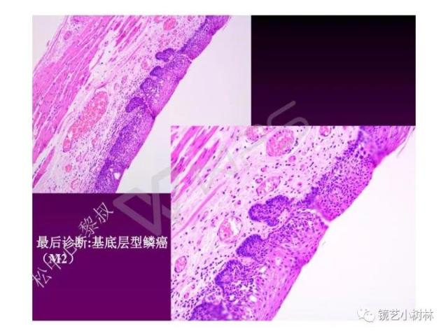 上消化道早癌病理的学习心得体会（附胃牵手癌的病例特点文献学习）