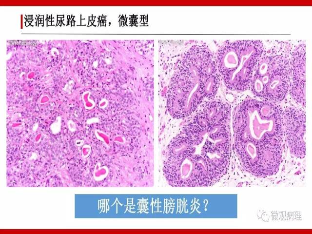泌尿课程/浸润性尿路上皮癌病理学类型