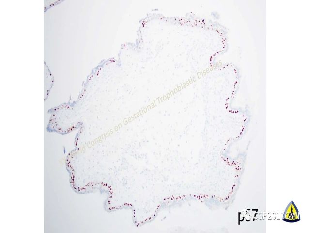 p57免疫组化染色及基因分型 在葡萄胎精确诊断中的应用