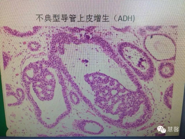 低级别DCIS？（李晟磊分享，孔祥田等讨论）