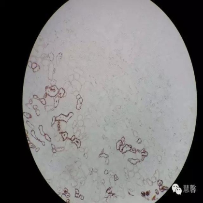 透明细胞乳头状肾细胞癌？TFE3 Traslocation Carcinoma？（赵洋分享，孔祥田(Max)*NM老师讲解）