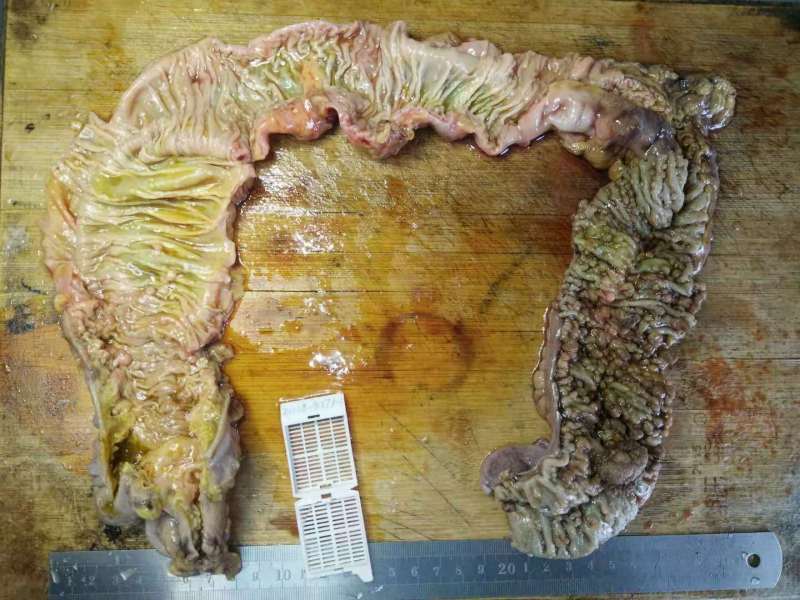 病理科工作札记（二十五）家族性大肠腺瘤病
