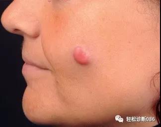 皮肤淋巴瘤(12)——T-NHL（罕见亚型）