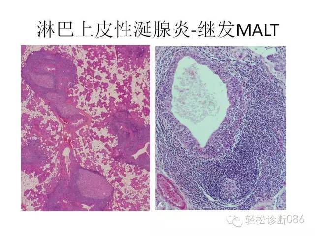 边缘区淋巴瘤（附小B细胞NHL鉴别诊断）