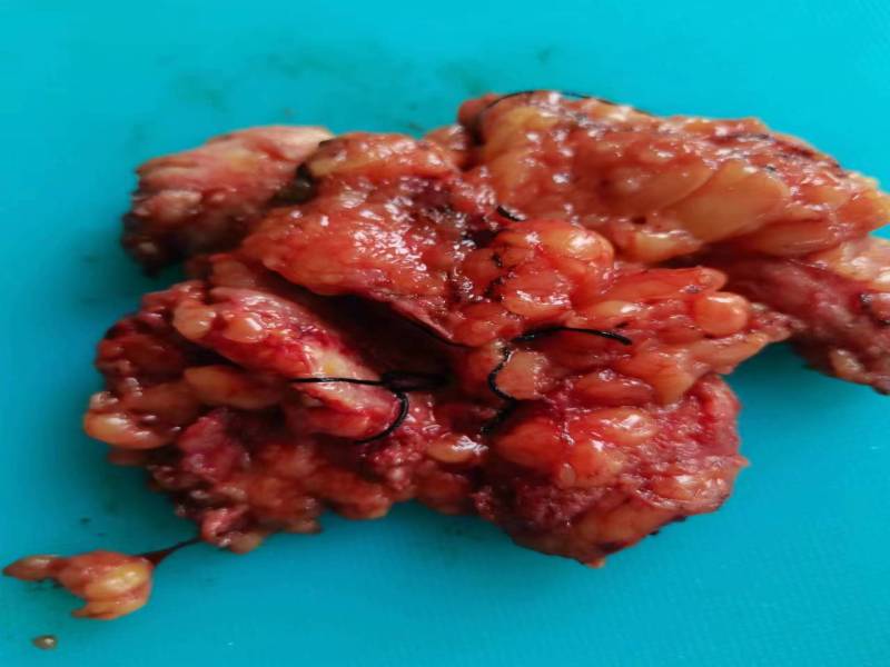 术中冰冻诊断有分歧的乳腺浸润性癌（九十）