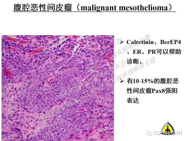 中华病理学会基层培训遵义站讲座（一）——卵巢和输卵管浆液性肿瘤的诊断和鉴别诊断