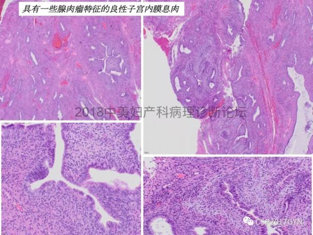 子宫内膜假肿瘤性病变及类似癌样病变