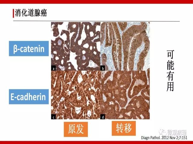 泌尿课程/尿路腺样病变的诊断要点