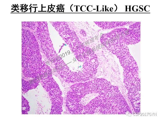 中华病理学会基层培训遵义站讲座（一）——卵巢和输卵管浆液性肿瘤的诊断和鉴别诊断