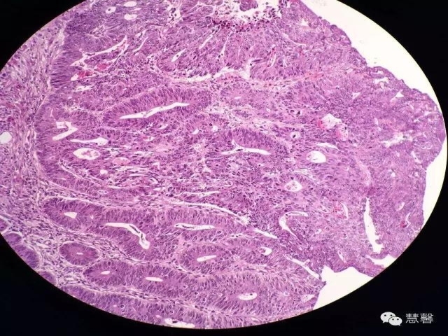 结、直肠管绒毛状腺瘤-高级别病变诊断等相关问题2（悄悄分享、孔祥田(Max)*Roswell*老师讲解）