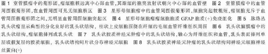 具有血管性菊形团/乳头状结构的中枢神经系统