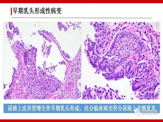 泌尿课程/尿路上皮病变的基本生长方式