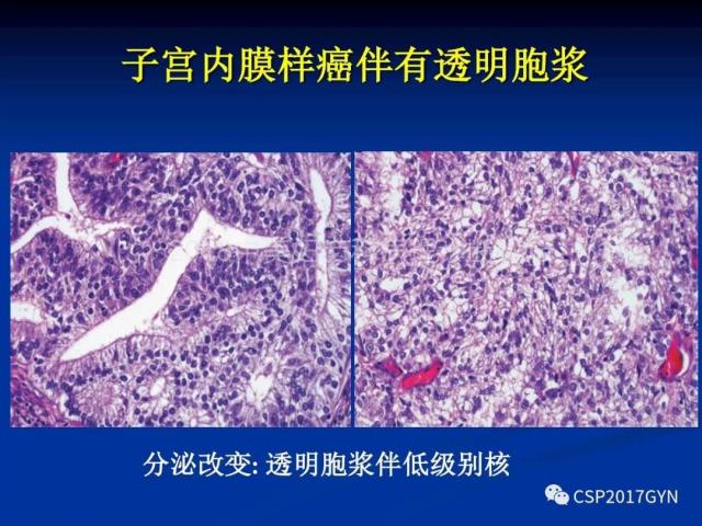 子宫内膜癌：诊断与进展