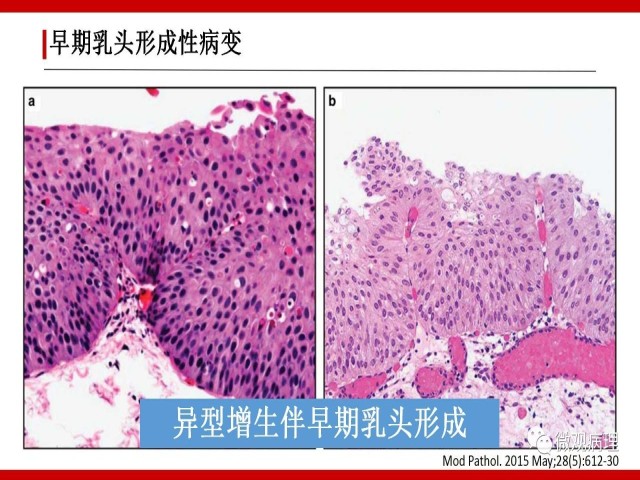 泌尿课程/尿路上皮病变的基本生长方式