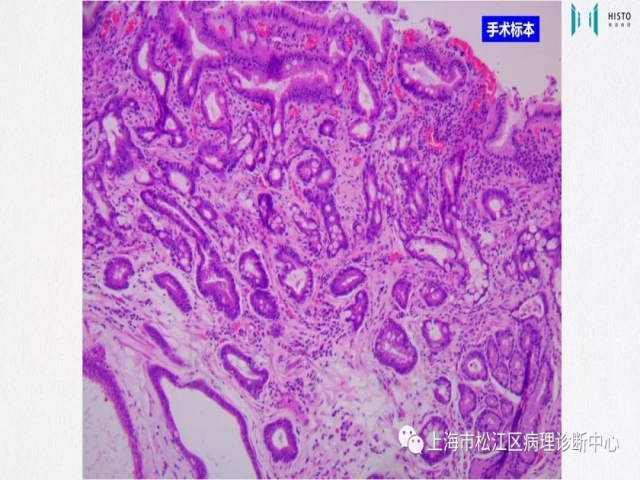 上消化道早癌病理诊断中的困惑及基本对策回顾
