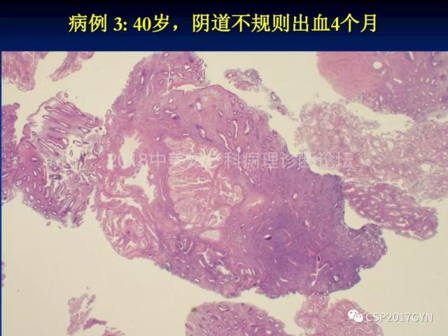 子宫内膜癌：诊断与进展