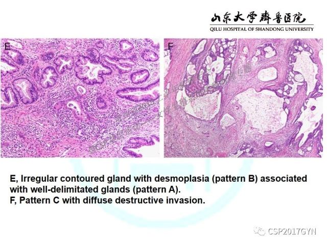 中华病理学会基层培训遵义站讲座（四）——宫颈腺癌的诊断及新分型